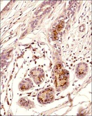 Immunohistochemistry-Paraffin: BRIP1/FANCJ Antibody (GO11-3E6) [NB100-350] - Analysis of a FFPE tissue section of the human breast cancer using 1:200 dilution of BRIP1/FANCJ antibody (NB100-350). The signal was developed using HRP-DAB method which followed counterstaining of the cells with hematoxylin. The antibody generated a nuclear stain in ductal cells with some cytoplasmic localization.