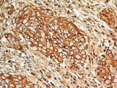 Immunohistochemistry: BST2 Antibody (2E2) - Azide and BSA Free [NBP2-80603] - Analysis of BST2 protein in a section of human lung cancer (squamous cell carcinoma) using 5 ug/ml concentration of BST2 antibody (clone 2E2). The carcinoma cells depicted distinct membrane-cytoplasmic BST2 positivity with more intense staining in the cel