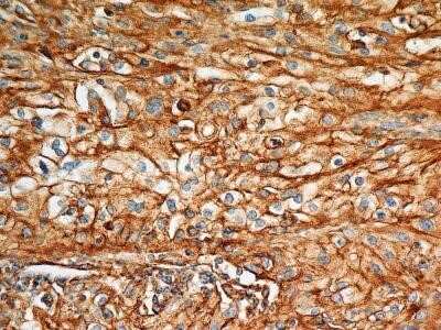 Immunohistochemistry: BST2 Antibody (2E2) - Azide and BSA Free [NBP2-80603] - Analysis of BST2 protein in a section of human renal cell carcinoma (clear cell type) using 5 ug/ml concentration of BST2 antibody (clone 2E2). The carcinoma cells depicted distinct membrane-cytoplasmic BST2 positivity with more intense staining in cellul