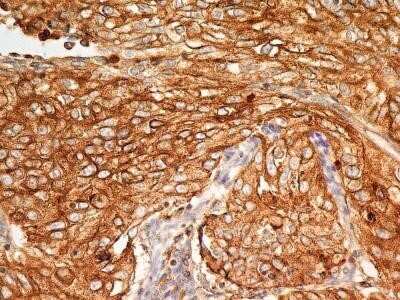 Immunohistochemistry-Paraffin: BST2 Antibody (2E2) - Azide and BSA Free [NBP2-80603] - Analysis of BST2 protein in a section of human endometrial carcinoma using 5 ug/ml concentration of BST2 antibody (clone 2E2). The carcinoma cells depicted distinct membrane-cytoplasmic BST2 positivity with more intense staining in the cellular membranes,