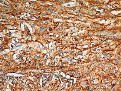 Immunohistochemistry-Paraffin: BST2 Antibody (2E2) [NBP2-29621] - Analysis of BST2 protein in a section of human renal cell carcinoma (clear cell type) using 5 ug/ml concentration of BST2 antibody (clone 2E2). The carcinoma cells depicted distinct membrane-cytoplasmic BST2 positivity with more intense staining in cellular membranes.