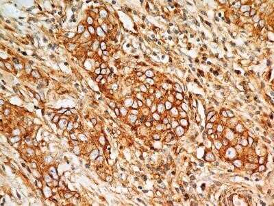 Immunohistochemistry: BST2 Antibody (4F6) - Azide and BSA Free [NBP2-80604] - Analysis of BST2 protein in a section of human lung cancer (squamous cell carcinoma) using 5 ug/mL concentration of BST2 antibody (clone 4F6). The carcinoma cells depicted strong membrane-cytoplasmic BST2 positivity with more intense staining in the cellu