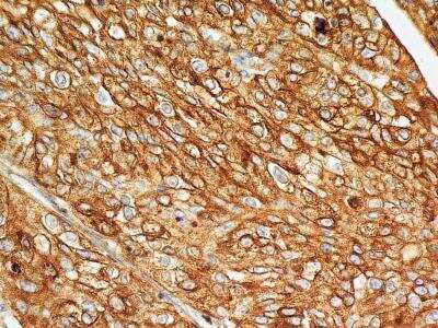 Immunohistochemistry-Paraffin: BST2 Antibody (4F6) [NBP2-29622] - Analysis of BST2 protein in a section of human endometrial carcinoma using 5 ug/mL concentration of BST2 antibody (clone 4F6). The carcinoma cells depicted distinct membrane-cytoplasmic BST2 positivity with more intense staining in the cellular membranes.