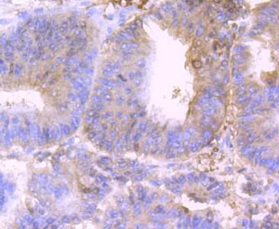 Immunohistochemistry-Paraffin: BST2 Antibody (JU11-93) [NBP2-75423] - Analysis of paraffin-embedded human colon cancer tissue using anti-BST2 antibody. Counter stained with hematoxylin.