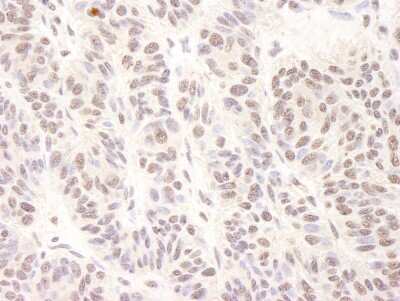 Immunohistochemistry: BTF Antibody [NB100-1704] - Sample: FFPE section of human skin carcinoma. Antibody: Affinity purified rabbit anti-BTF used at a dilution of 1:1,000 (0.2ug/ml). Detection: DAB staining using Immunohistochemistry Accessory Kit.