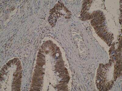 Immunohistochemistry: BTF Antibody (M33-P5B11) [NBP2-50118] - IHC was performed on formalin-fixed, paraffin-embedded tissue sections using Anti-BCLAF1 [M33-P5B11]. Image is showing both cytoplasmic and nuclear localisation positivity of BCLAF1 in colon cancer which is in agreement with existing literature. Exclusively nuclear localisation of BCLAF1 is observed in non-neoplastic colon mucosa. Antigen retrieval step was required (microwave 10 min @ 950W in 0.01M sodium citrate buffer, pH 6.0).