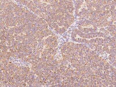 Immunohistochemistry-Paraffin: BTG4 Antibody [NBP3-05926] - Staining of human BTG4 in human ovarian cancer with rabbit polyclonal antibody at 1:100 dilution.