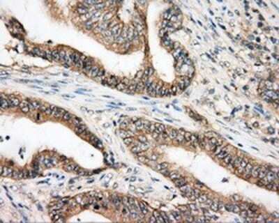 Immunohistochemistry: BTK Antibody (OTI3A2) - Azide and BSA Free [NBP2-70291] - Staining of paraffin-embedded Adenocarcinoma of colon tissue using anti-BTK mouse monoclonal antibody.