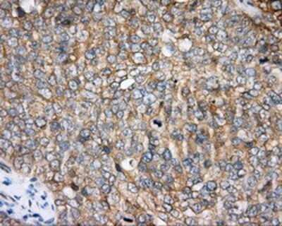 Immunohistochemistry: BTK Antibody (OTI3A2) - Azide and BSA Free [NBP2-70291] - Staining of paraffin-embedded Adenocarcinoma of ovary tissue using anti-BTK mouse monoclonal antibody.