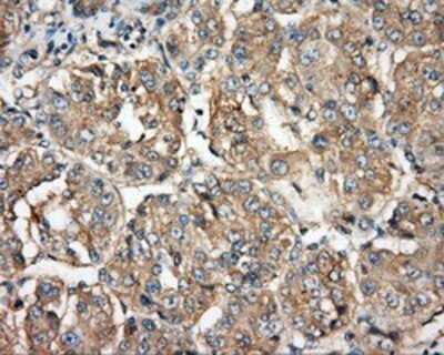 Immunohistochemistry: BTK Antibody (OTI3A2) - Azide and BSA Free [NBP2-70291] - Staining of paraffin-embedded Carcinoma of liver tissue using anti-BTK mouse monoclonal antibody.