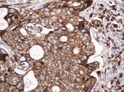 Immunohistochemistry: BTLA/CD272 Antibody (OTI2E4) - Azide and BSA Free [NBP2-72427] - Analysis of Adenocarcinoma of Human breast tissue. (Heat-induced epitope retrieval by 10mM citric buffer, pH6.0, 120C for 3min)