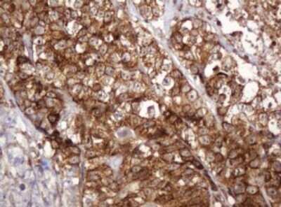 Immunohistochemistry: BTLA/CD272 Antibody (OTI2E4) - Azide and BSA Free [NBP2-72427] - Analysis of Adenocarcinoma of Human colon tissue. (Heat-induced epitope retrieval by 10mM citric buffer, pH6.0, 120C for 3min)