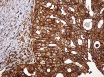 Immunohistochemistry: BTLA/CD272 Antibody (OTI2E4) - Azide and BSA Free [NBP2-72427] - Analysis of Adenocarcinoma of Human ovary tissue. (Heat-induced epitope retrieval by 10mM citric buffer, pH6.0, 120C for 3min)