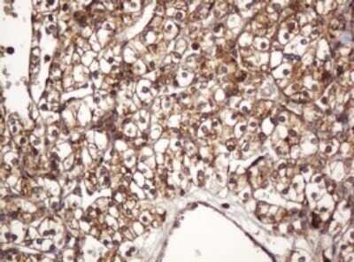 Immunohistochemistry: BTLA/CD272 Antibody (OTI2E4) - Azide and BSA Free [NBP2-72427] - Analysis of Carcinoma of Human kidney tissue. (Heat-induced epitope retrieval by 10mM citric buffer, pH6.0, 120C for 3min)