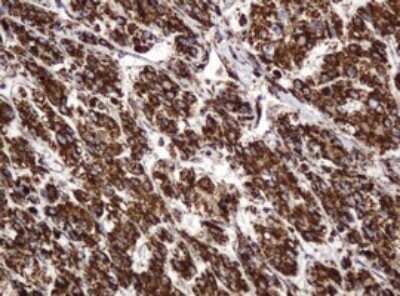 Immunohistochemistry: BTLA/CD272 Antibody (OTI2E4) - Azide and BSA Free [NBP2-72427] - Analysis of Carcinoma of Human liver tissue.(Heat-induced epitope retrieval by 10mM citric buffer, pH6.0, 120C for 3min)