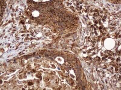 Immunohistochemistry: BTLA/CD272 Antibody (OTI2E4) - Azide and BSA Free [NBP2-72427] - Analysis of Carcinoma of Human lung tissue. (Heat-induced epitope retrieval by 10mM citric buffer, pH6.0, 120C for 3min)