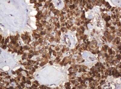 Immunohistochemistry: BTLA/CD272 Antibody (OTI2E4) - Azide and BSA Free [NBP2-72427] - Analysis of Carcinoma of Human pancreas tissue. (Heat-induced epitope retrieval by 10mM citric buffer, pH6.0, 120C for 3min)