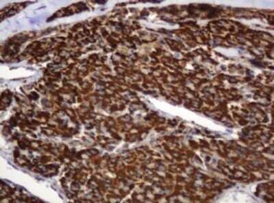 Immunohistochemistry: BTLA/CD272 Antibody (OTI2E4) - Azide and BSA Free [NBP2-72427] - Analysis of Carcinoma of Human thyroid tissue. (Heat-induced epitope retrieval by 10mM citric buffer, pH6.0, 120C for 3min)