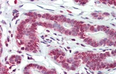 Immunohistochemistry-Paraffin: BXDC5 Antibody [NBP1-80467] - Human Breast, antibody concentration 5.0ug/ml.