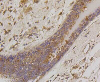 Immunohistochemistry-Paraffin: Bad Antibody (SA32-01) [NBP2-67308] - Analysis of paraffin-embedded human breast carcinoma tissue using anti-Bad antibody. Counter stained with hematoxylin.