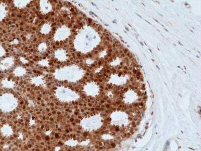 Immunohistochemistry: Bag-1 Antibody (RM356) [NBP2-77438] - Immunohistochemical staining of formalin fixed and paraffin embedded human breast cancer tissue sections using NBP2-77438.