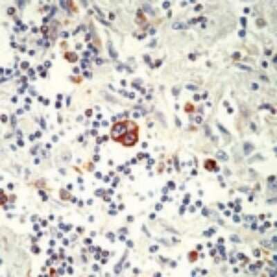 Immunohistochemistry-Paraffin: Bax Antibody (2D2) [NBP2-26447] - IHC analysis of bax, Apoptosis Marker formalin-fixed paraffin embedded human Hodgkin's lymphoma using NBP2-26447.