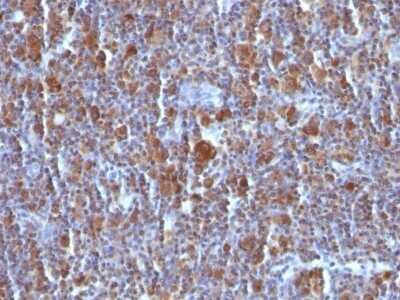 Immunohistochemistry-Paraffin: Bax Antibody (BAX/962) - Azide and BSA Free [NBP2-47815] - Hodgkin's Lymphoma stained with Bax Monoclonal Antibody (BAX/962).