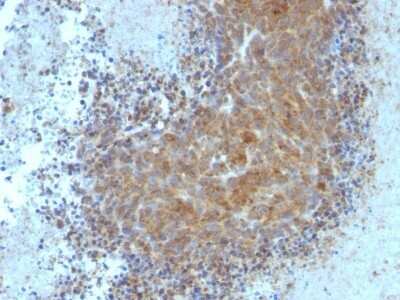 Immunohistochemistry-Paraffin: Bax Antibody (BAX/962) - Azide and BSA Free [NBP2-47815] - Human Melanoma stained with Bax Monoclonal Antibody (BAX/962).