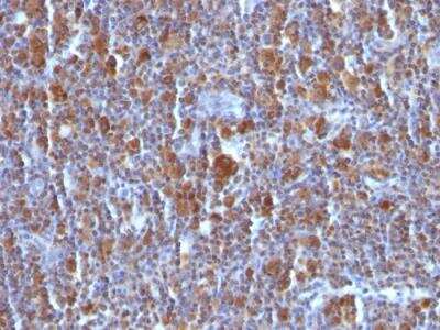 Immunohistochemistry-Paraffin: Bax Antibody (BAX/962) - IHC-Prediluted [NBP2-48256] - Formalin-fixed, paraffin-embedded Hodgkin's Lymphoma stained with BAX Mouse Monoclonal Antibody (BAX/962).