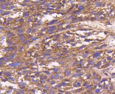 Immunohistochemistry-Paraffin: Bax Antibody (SZ3-07) [NBP2-67365] - Analysis of paraffin-embedded human breast carcinoma tissue using anti-Bax antibody. Counter stained with hematoxylin.