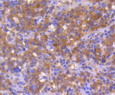 Immunohistochemistry-Paraffin: Bax Antibody (SZ3-07) [NBP2-67365] - Analysis of paraffin-embedded human liver cancer tissue using anti-Bax antibody. Counter stained with hematoxylin.