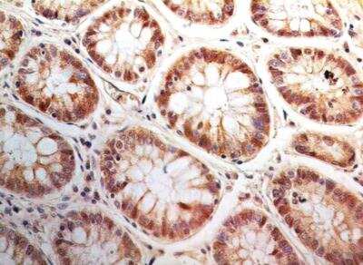 Immunohistochemistry-Paraffin: Bax inhibitor 1 Antibody (20F430) - Azide Free [NBP2-33264] - Formalin-fixed, paraffin-embedded human adenocarcinoma of the rectum stained with Bi-1 antibody (5 ug/ml), peroxidase-conjugate and DAB chromogen. Staining of formalin-fixed tissues is enhanced by boiling tissue sections in 10 mM sodium citrate buffer, pH 6.0 for 10-20 min followed by cooling at RT for 20 min.