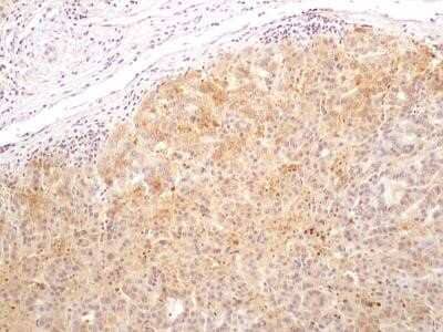 Immunohistochemistry-Paraffin: Bax inhibitor 1 Antibody (20F565) - Azide and BSA Free [NBP2-80591] - IHC analysis of formalin-fixed paraffin-embedded tissue section of human liver cancer using 5 ug/ml concentration of Bax inhibitor 1 antibody (clone 20F565). Cytoplasmic immuno-positivity of Bax inhibitor 1 (TMBIM6) was observed in the hepatis cancer cell
