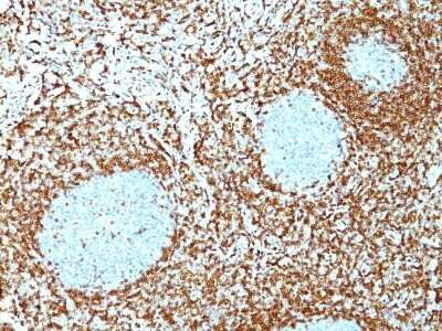 Immunohistochemistry-Paraffin: Bcl-2 Antibody (100/D5+124) - Azide and BSA Free [NBP2-34515] - Formalin-fixed, paraffin-embedded human non-Hodgkin's lymphoma stained with Bcl-2 MAb (100/D5 + 124). Note nuclear membrane & cytoplasmic staining.