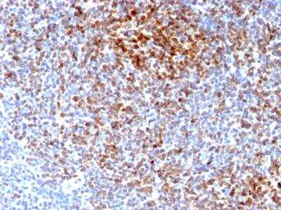 Immunohistochemistry-Paraffin: Bcl-2 Antibody (BCL2/2210R) - Azide and BSA Free [NBP2-75764] - FFPE human Follicular Lymphoma stained with Bcl-2 Rabbit Recombinant Monoclonal Antibody (BCL2/2210R).