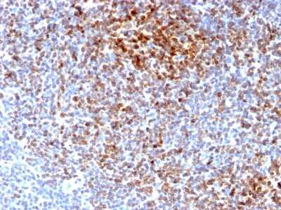 Immunohistochemistry-Paraffin: Bcl-2 Antibody (BCL2/2210R) [NBP2-75761] - Formalin-fixed, paraffin-embedded human Follicular Lymphoma stained with Bcl-2 Antibody (BCL2/2210R).