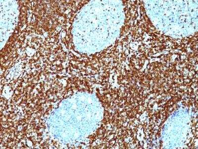 Immunohistochemistry-Paraffin: Bcl-2 Antibody (BCL2/782 + BCL2/796) - IHC-Prediluted [NBP2-48303] - Human non-Hodgkin's lymphoma stained with Bcl-2 Monoclonal Antibody (BCL2/782 + BCL2/796).