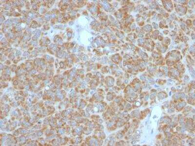 Immunohistochemistry-Paraffin: Bcl-2 Antibody (BCL2/782 + BCL2/796) - IHC-Prediluted [NBP2-48303] - Human Melanoma stained with Bcl-2 Monoclonal Antibody (BCL2/782 + BCL2/796).