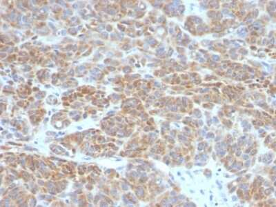 Immunohistochemistry-Paraffin: Bcl-2 Antibody (BCL2/782) [NBP2-44783] - Human Melanoma stained with Bcl-2 Monoclonal Antibody (BCL2/782).