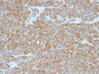 Immunohistochemistry-Paraffin: Bcl-2 Antibody (BCL2/796) - Azide and BSA Free [NBP2-47852] - Human Melanoma stained with Bcl-2 Mouse Monoclonal Antibody (BCL2/796).