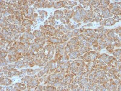 Immunohistochemistry-Paraffin: Bcl-2 Antibody (BCL2/796) [NBP2-44784] - Human Melanoma stained with Bcl-2 Monoclonal Antibody (BCL2/796).