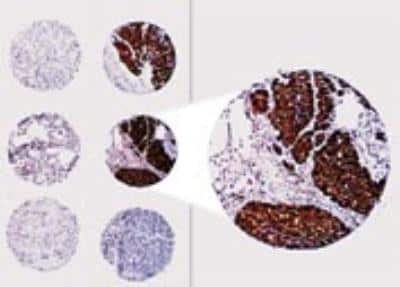 Immunohistochemistry-Paraffin: Bcl-2 Antibody [NB100-56102] - Formalin-fixed paraffin-embedded section of a human prostate cancer tissue array stained for Bcl-2 expression using this antibody at 1:2000. Hematoxylin-eosin counterstain.