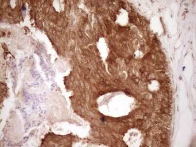 Immunohistochemistry: Bcl-2 Antibody (OTI9D3) - Azide and BSA Free [NBP2-70245] - Analysis of Adenocarcinoma of Human breast tissue. (Heat-induced epitope retrieval by 1 mM EDTA in 10mM Tris, pH8.5, 120°C for 3min)