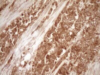 Immunohistochemistry: Bcl-2 Antibody (OTI9D3) - Azide and BSA Free [NBP2-70245] - Analysis of Adenocarcinoma of Human endometrium tissue. (Heat-induced epitope retrieval by 1 mM EDTA in 10mM Tris, pH8.5, 120C for 3min)