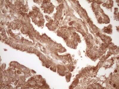 Immunohistochemistry: Bcl-2 Antibody (OTI9D3) - Azide and BSA Free [NBP2-70245] - Analysis of Adenocarcinoma of Human ovary tissue. (Heat-induced epitope retrieval by 1 mM EDTA in 10mM Tris, pH8.5, 120C for 3min)