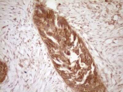 Immunohistochemistry: Bcl-2 Antibody (OTI9D3) - Azide and BSA Free [NBP2-70245] - Analysis of Carcinoma of Human kidney tissue. (Heat-induced epitope retrieval by 1 mM EDTA in 10mM Tris, pH8.5, 120C for 3min)