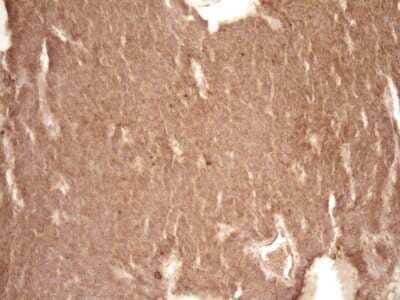 Immunohistochemistry: Bcl-2 Antibody (OTI9D3) - Azide and BSA Free [NBP2-70245] - Analysis of Carcinoma of Human lung tissue. (Heat-induced epitope retrieval by 1 mM EDTA in 10mM Tris, pH8.5, 120C for 3min)