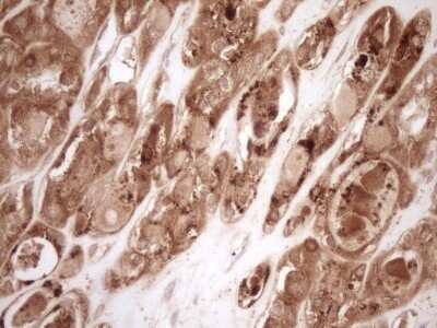 Immunohistochemistry: Bcl-2 Antibody (OTI9D3) - Azide and BSA Free [NBP2-70245] - Analysis of Carcinoma of Human thyroid tissue. (Heat-induced epitope retrieval by 1 mM EDTA in 10mM Tris, pH8.5, 120C for 3min)