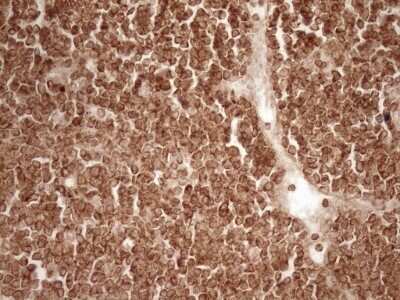 Immunohistochemistry: Bcl-2 Antibody (OTI9D3) - Azide and BSA Free [NBP2-70245] - Analysis of Human lymphoma tissue. (Heat-induced epitope retrieval by 1 mM EDTA in 10mM Tris, pH8.5, 120C for 3min)