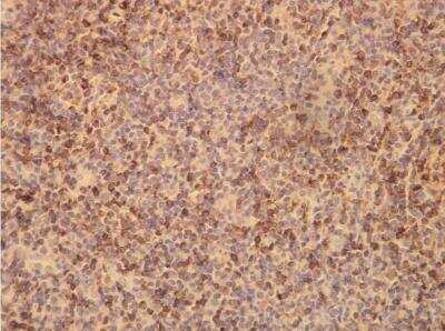 Immunohistochemistry-Paraffin: Bcl-2 Antibody (P21-A) [NBP1-79011] - Expression in diffuse large B-cell lymphoma.